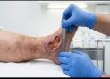 Complex Wounds